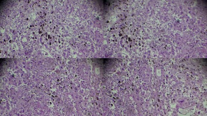 显微镜下的黑色素瘤活检放大不同区域