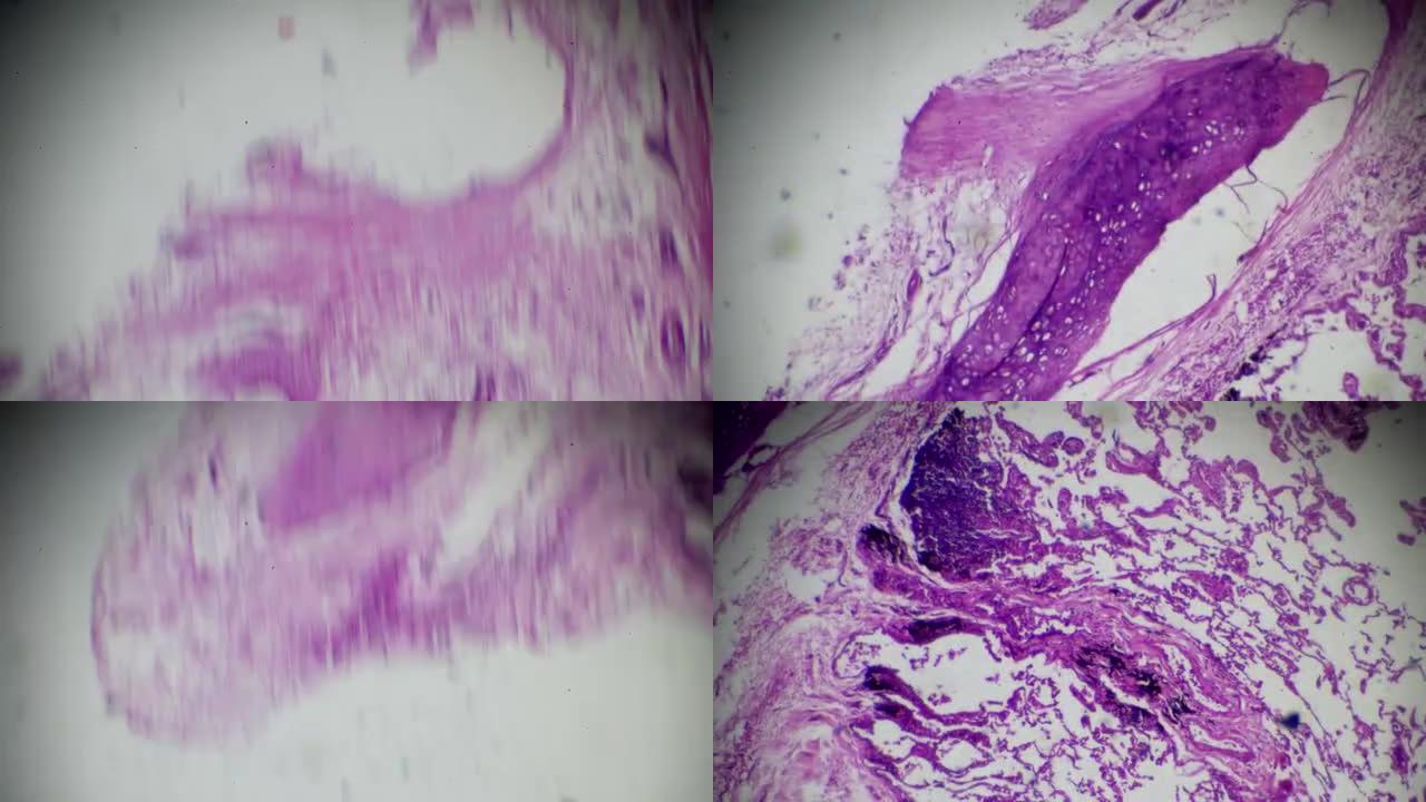 显微镜下的慢性支气管炎在不同区域放大