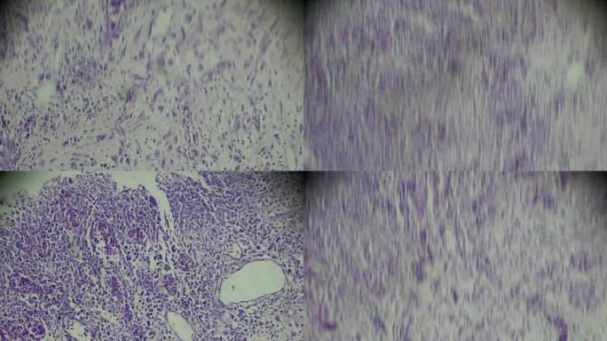 显微镜下肉芽组织人体病理样本
