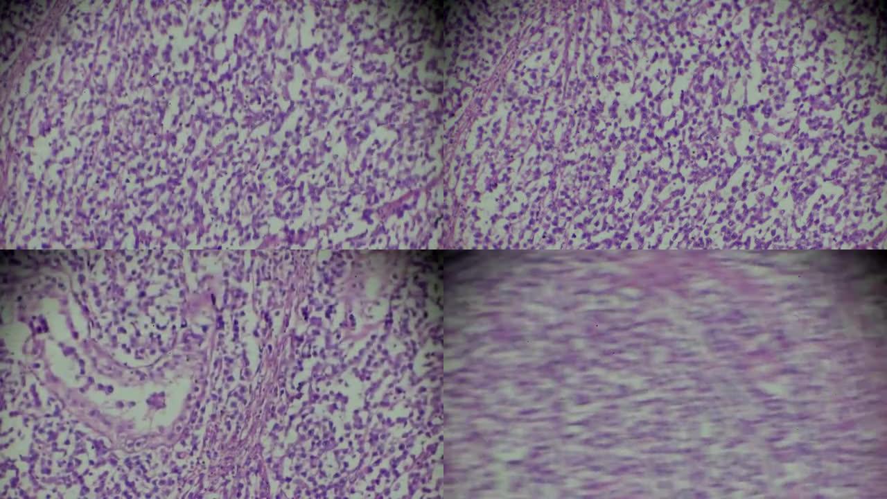 显微镜下的脑星形细胞瘤在不同范围内缩放