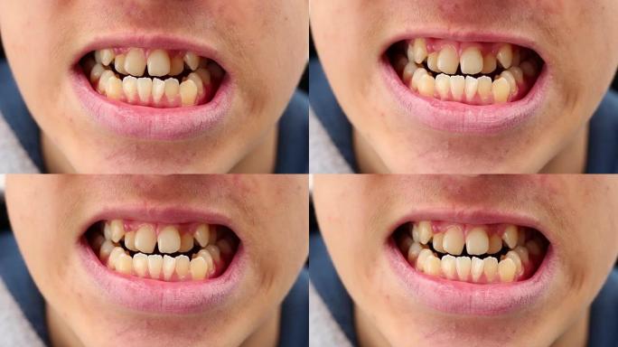 弯曲、拥挤和突出的牙齿