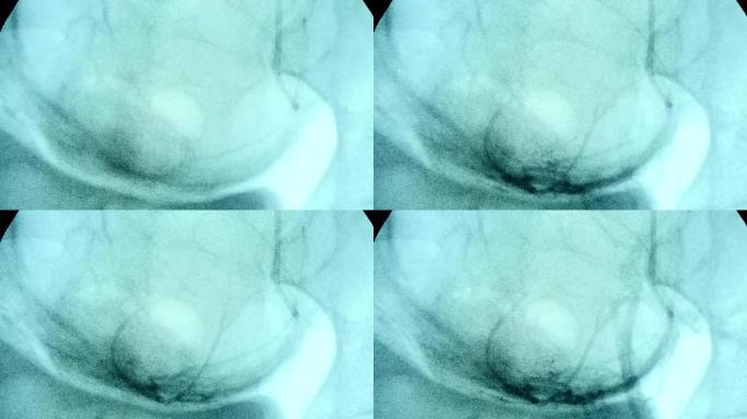 现代x射线监视器的蓝色大屏幕检查带有黑色动脉的乳房