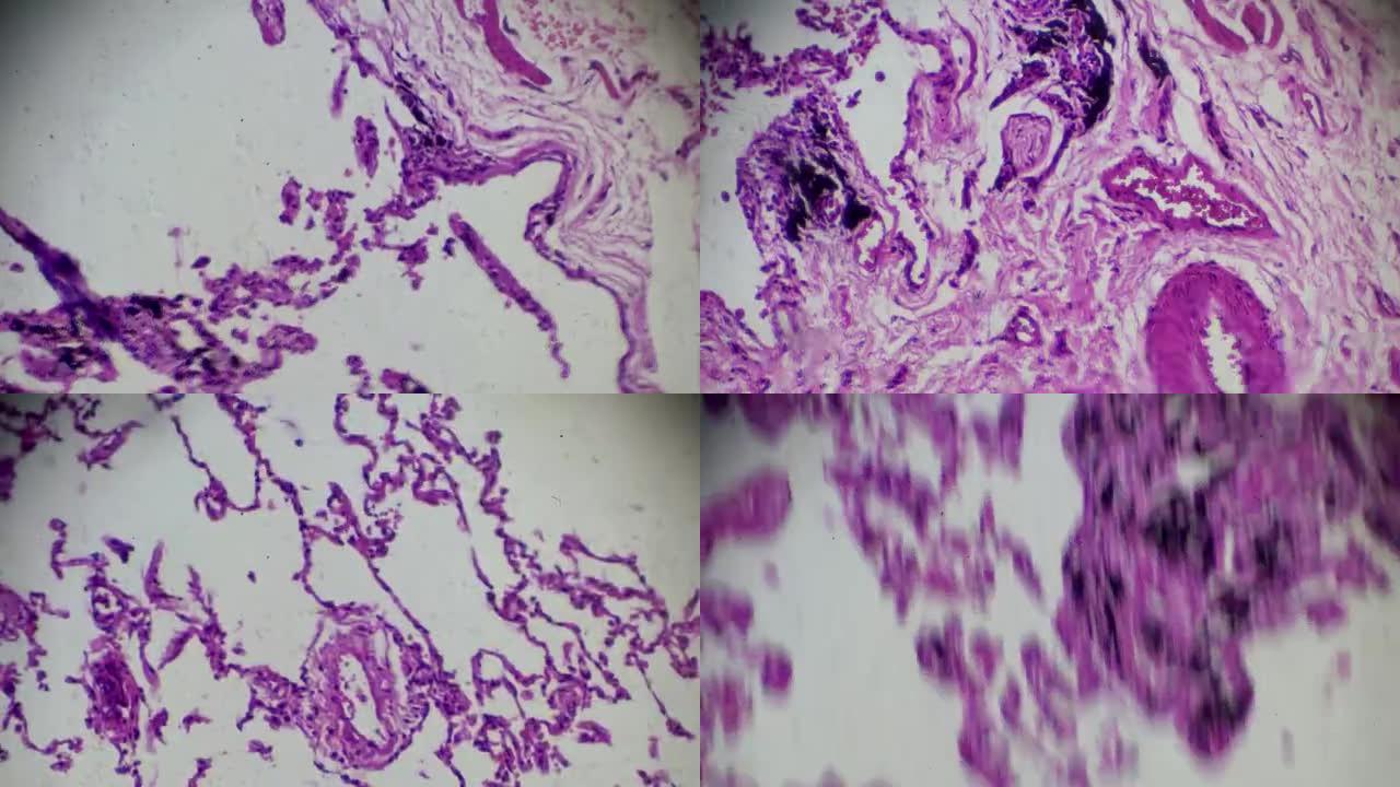 显微镜下的慢性支气管炎在不同区域放大