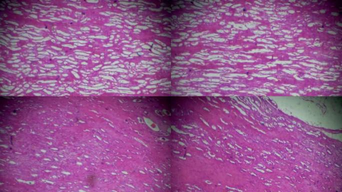 光学显微镜下的肾腺癌活检在不同区域的放大