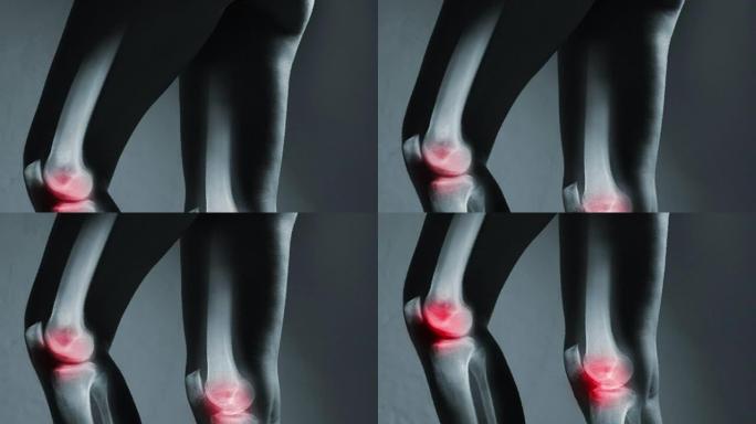 X射线下的人膝关节和腿，在灰色背景上