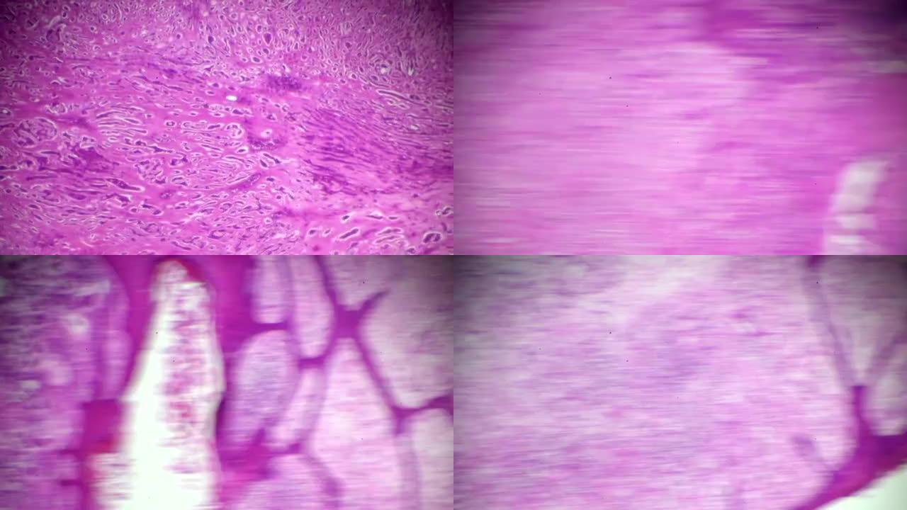 显微镜下的角膜炎麻风病理样本