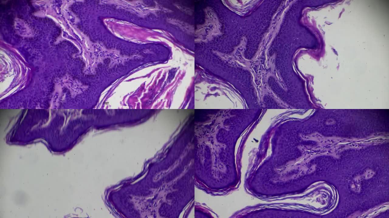 显微镜下皮肤乳头状瘤病理标本