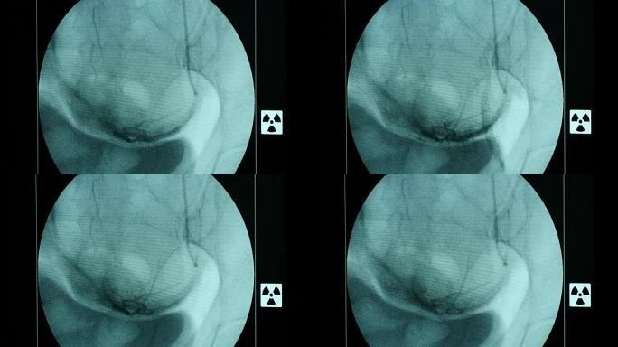 现代x射线设备的蓝色大屏幕上的呼吸女性乳房