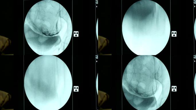 在新型x射线设备的圆形蓝屏上活着的女性乳房