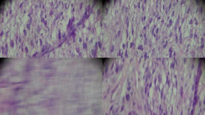 显微镜下横纹肌肉瘤活检在不同范围内放大