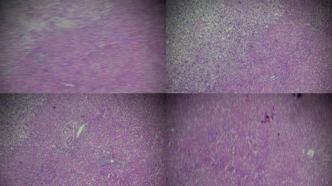 肝细胞癌，肝细胞癌镜下