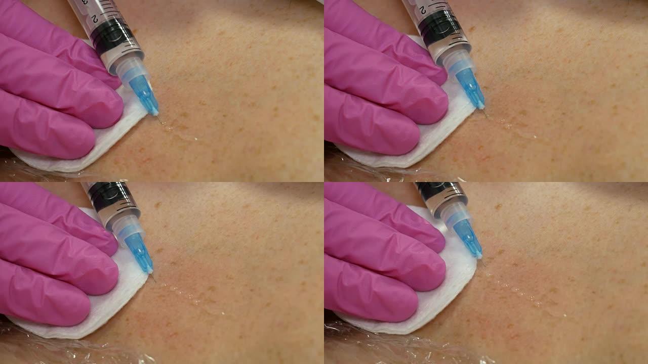 英俊的女人在脖子和胸部皮肤上注射该程序使医生戴着粉红色的手套。中间疗法的概念