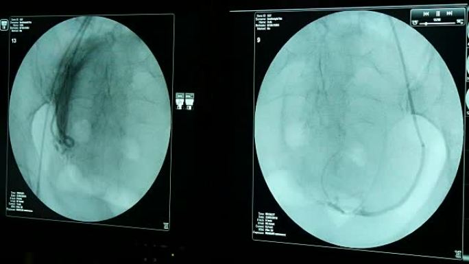 现代x射线设备的圆形蓝屏上的活着的女性胸部