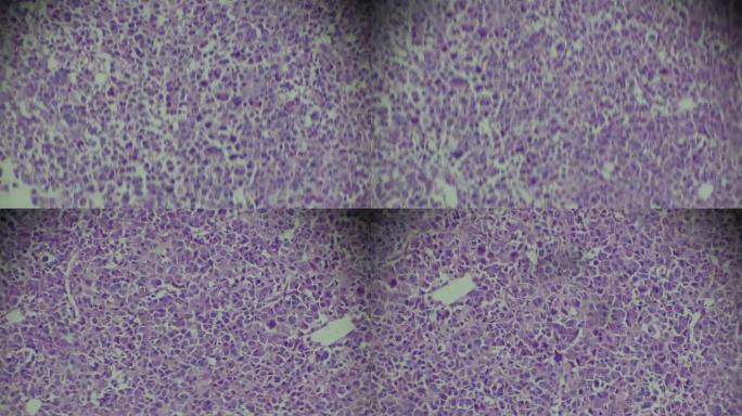 光学显微镜下骨肉瘤活检不同区域的变焦