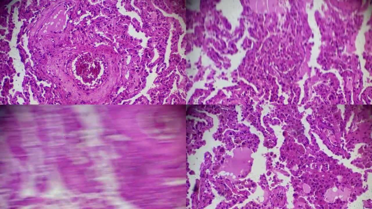 光学显微镜下不同区域的慢性肺充血