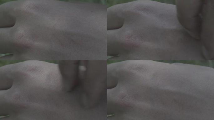 大量的蚊子 (埃及伊蚊) 吸血靠近人体皮肤。推迟并刮伤咬伤的地方