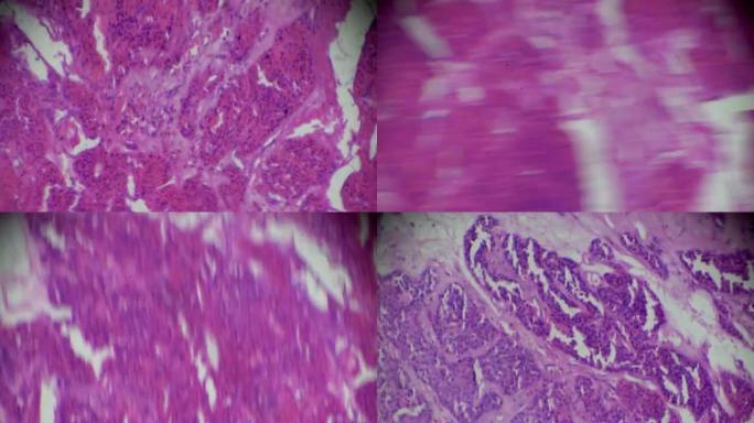 光学显微镜下的肾腺癌活检在不同区域的放大