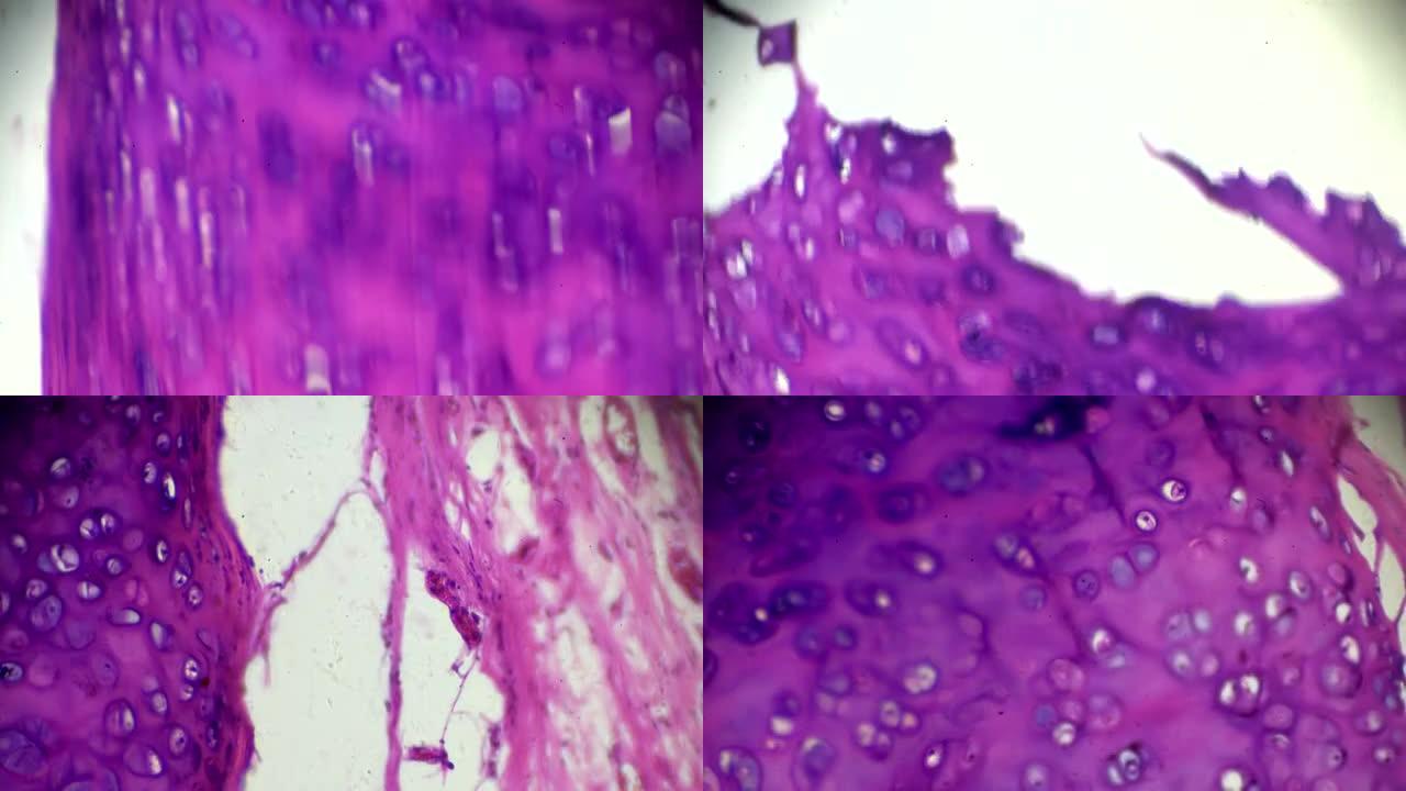 显微镜下的慢性支气管炎在不同区域放大