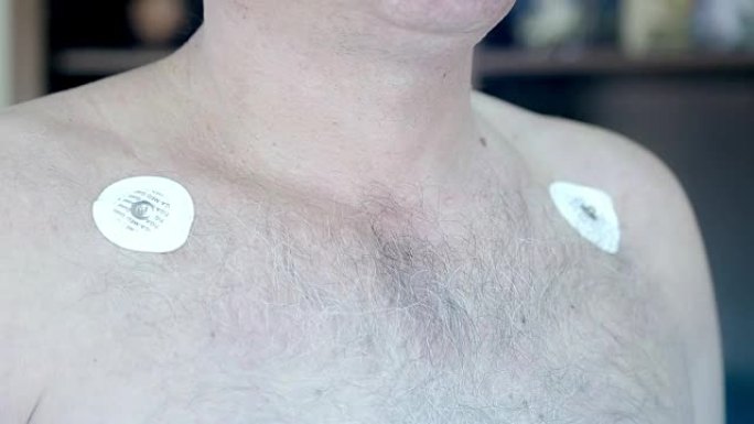 女医生将电极贴在患者的胸部，以进行日常监测。动态心电图监测装置
