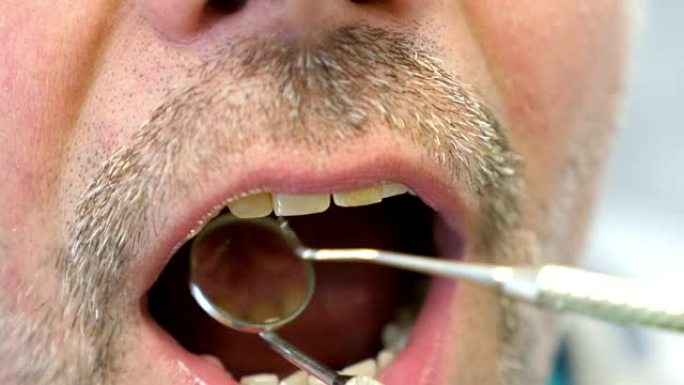 病人的嘴巴和牙医检查他的牙齿的近距离镜头