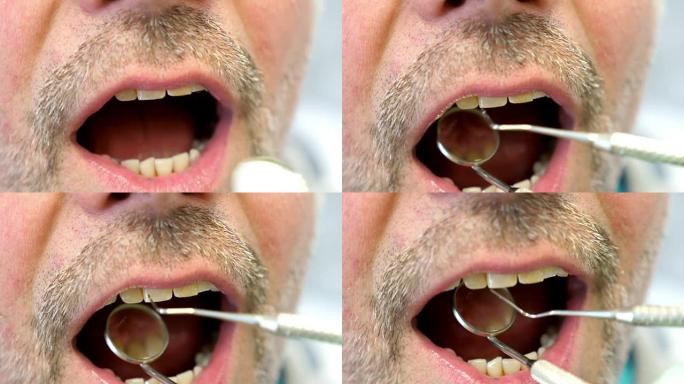 病人的嘴巴和牙医检查他的牙齿的近距离镜头