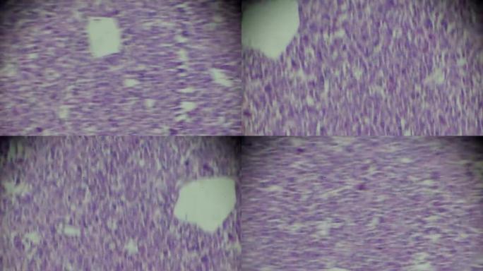 光学显微镜下骨肉瘤活检不同区域的变焦
