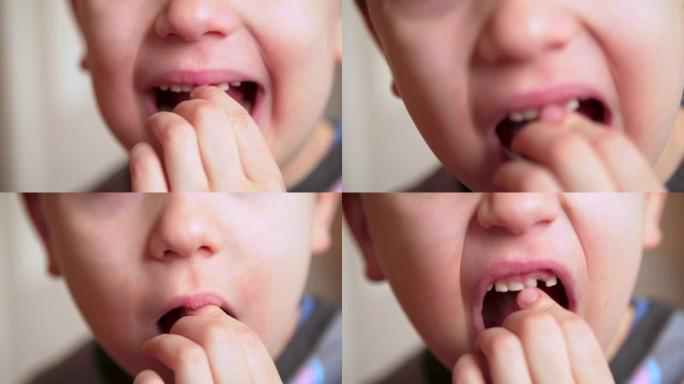 男孩扭动一颗松动的牙齿