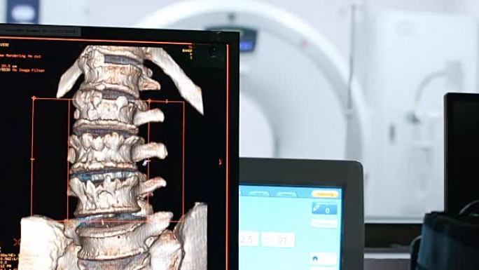 CT扫描仪显示腰椎骨折的计算机图像，