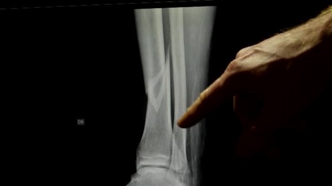 骨科医生指点胫骨骨折腿x线摄片