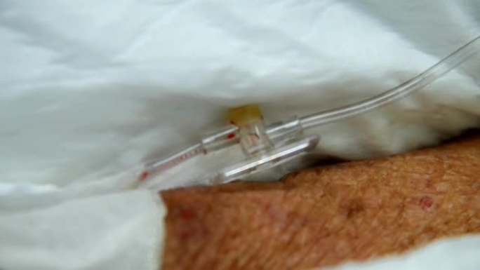 患者在医院接受生理盐水静脉注射