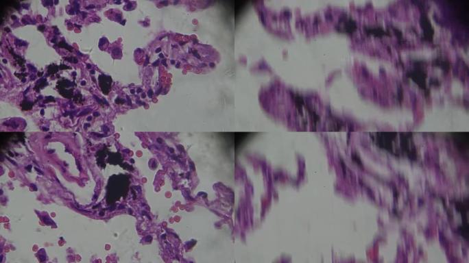 显微镜下的慢性支气管炎在不同区域放大