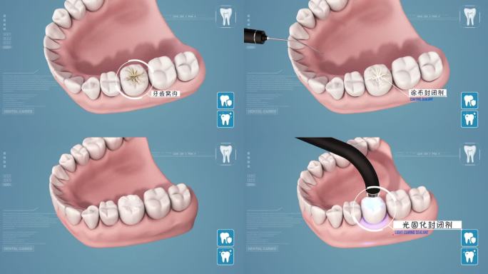 龋齿修复 窝沟封闭
