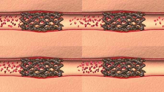 做完支架之后 血管内垃圾聚集形成新血栓