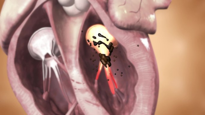 药物成分清除心脏瓣膜周围瘀堵 恢复供血