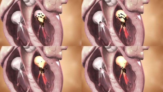 药物成分清除心脏瓣膜周围瘀堵 恢复供血