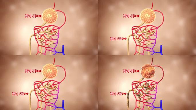 肾小球 肾小管由正常变为干瘪的动画