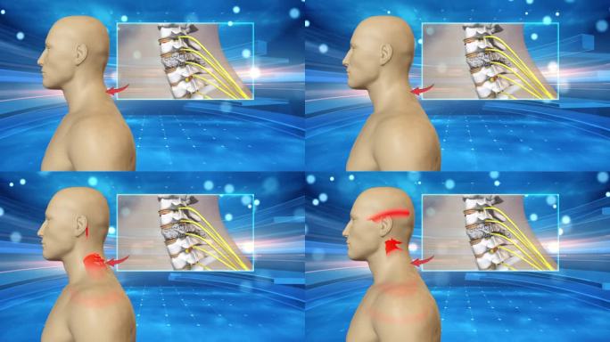 颈椎 压迫 血管