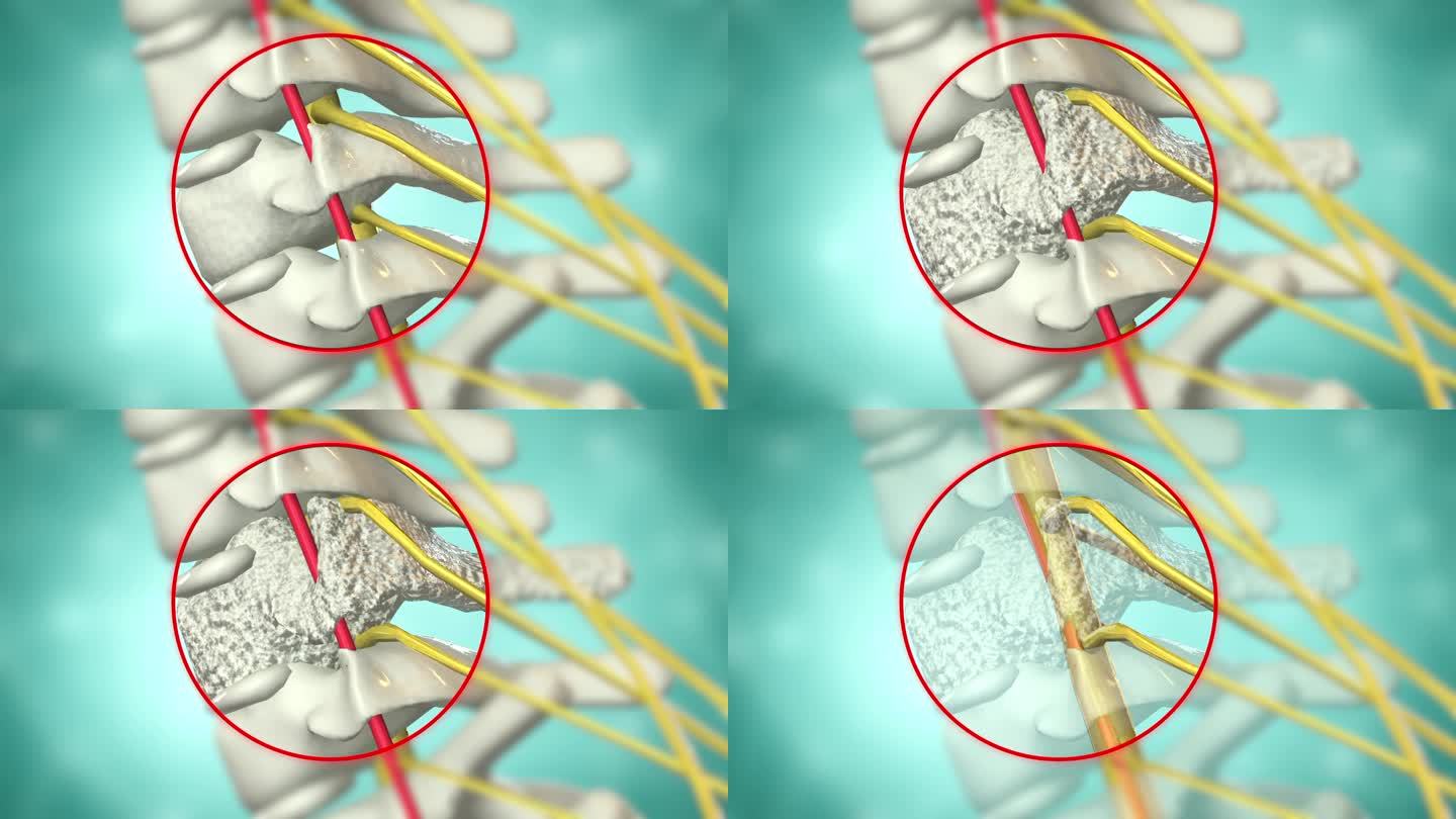 颈椎动画 颈椎骨增生变厚压迫神经 脊髓
