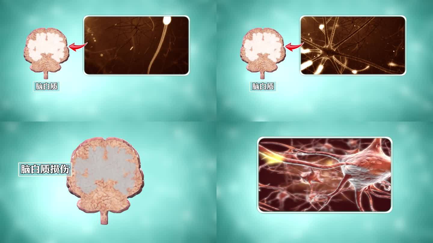 动画：大脑神经纤维聚集+脑白质损伤萎缩