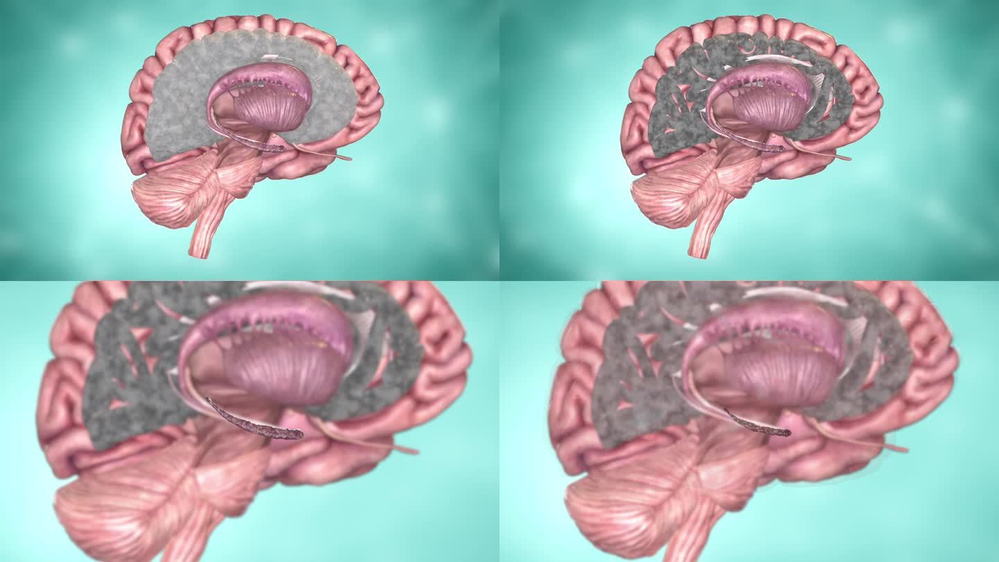 大脑萎缩的病理动画 脑白质减少