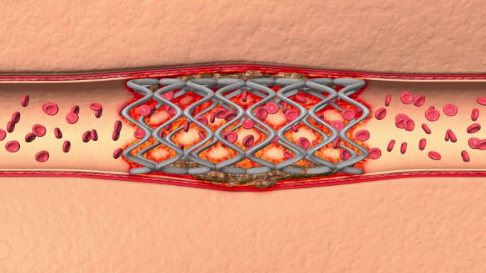 血管硬化严重支架出现炎症导致血聚集