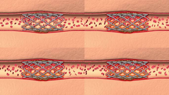 血管硬化严重支架出现炎症导致血聚集