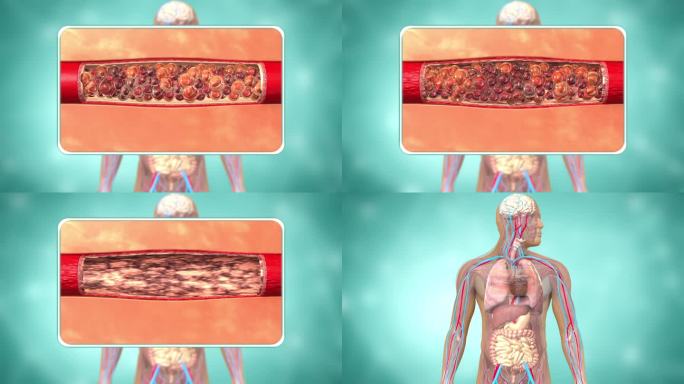 血糖 血压升高动画 人体模型 血管