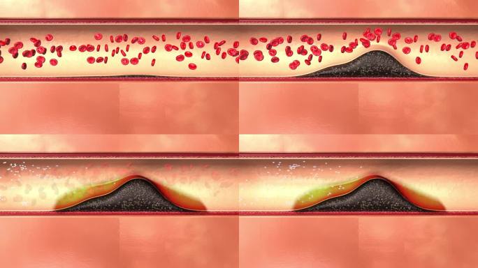 血管中的斑块上面包了一层皮 常规药物无法