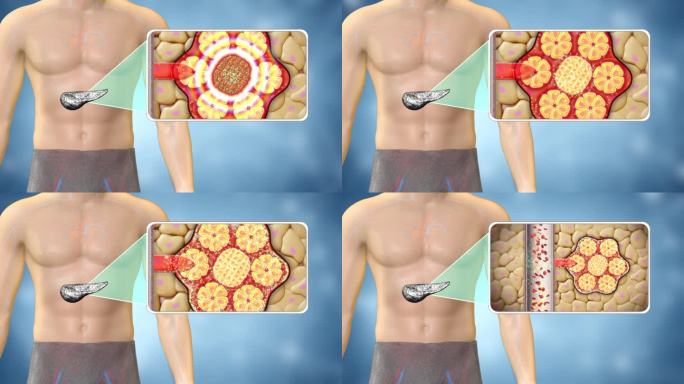 胰腺 恢复胰腺功能 让胰腺正常分泌胰岛素