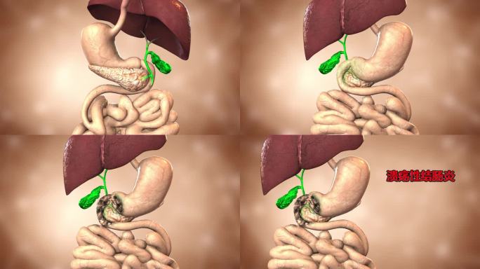 胆汁进入肠道 刺激肠道 导致十二指肠病变
