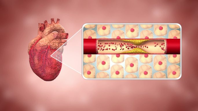 心肌纤维化放大到心肌细胞缺氧导致损伤