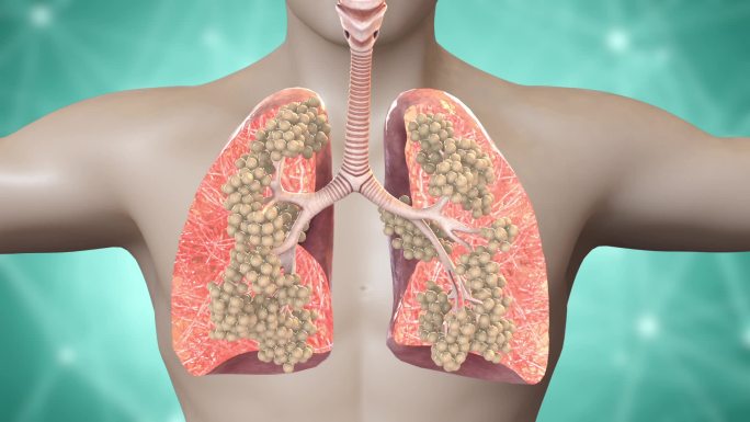 肺逐渐纤维化变成了结缔组织