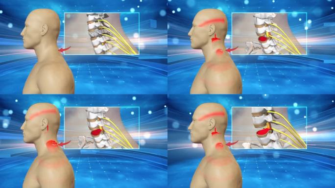 颈椎部位有压迫 椎体出现增生
