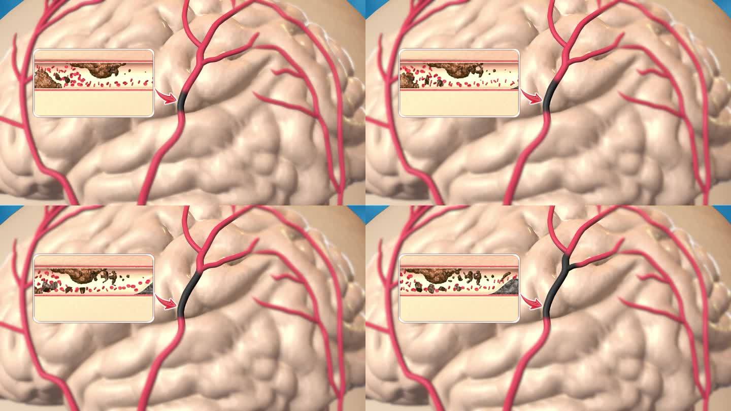 脑血管斑块，脱落形成栓塞——脑梗效果